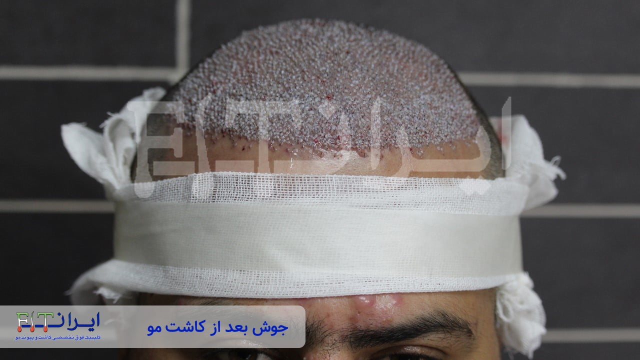 جوش بعد از کاشت مو