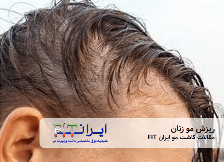 ریزش مو در زنان