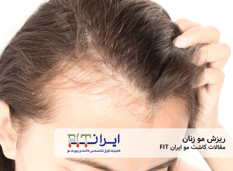 ریزش مو زنان
