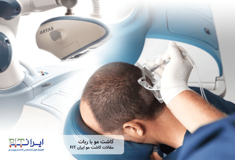 کاشت مو با ربات