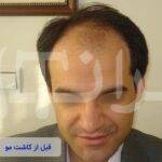 قبل و بعد از کاشت مو