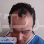 قبل و بعد از کاشت مو