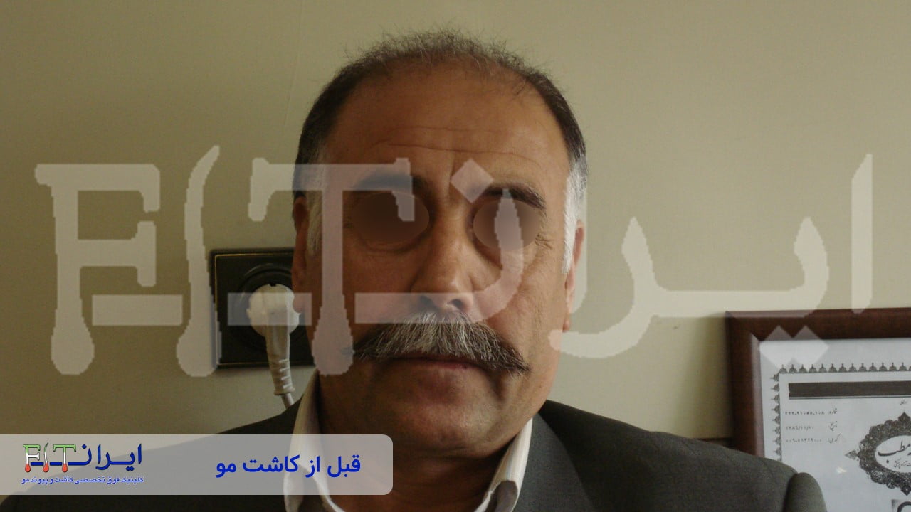 قبل و بعد از کاشت مو