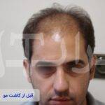 قبل و بعد از کاشت مو