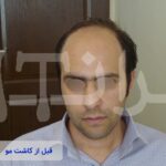 قبل و بعد از کاشت مو