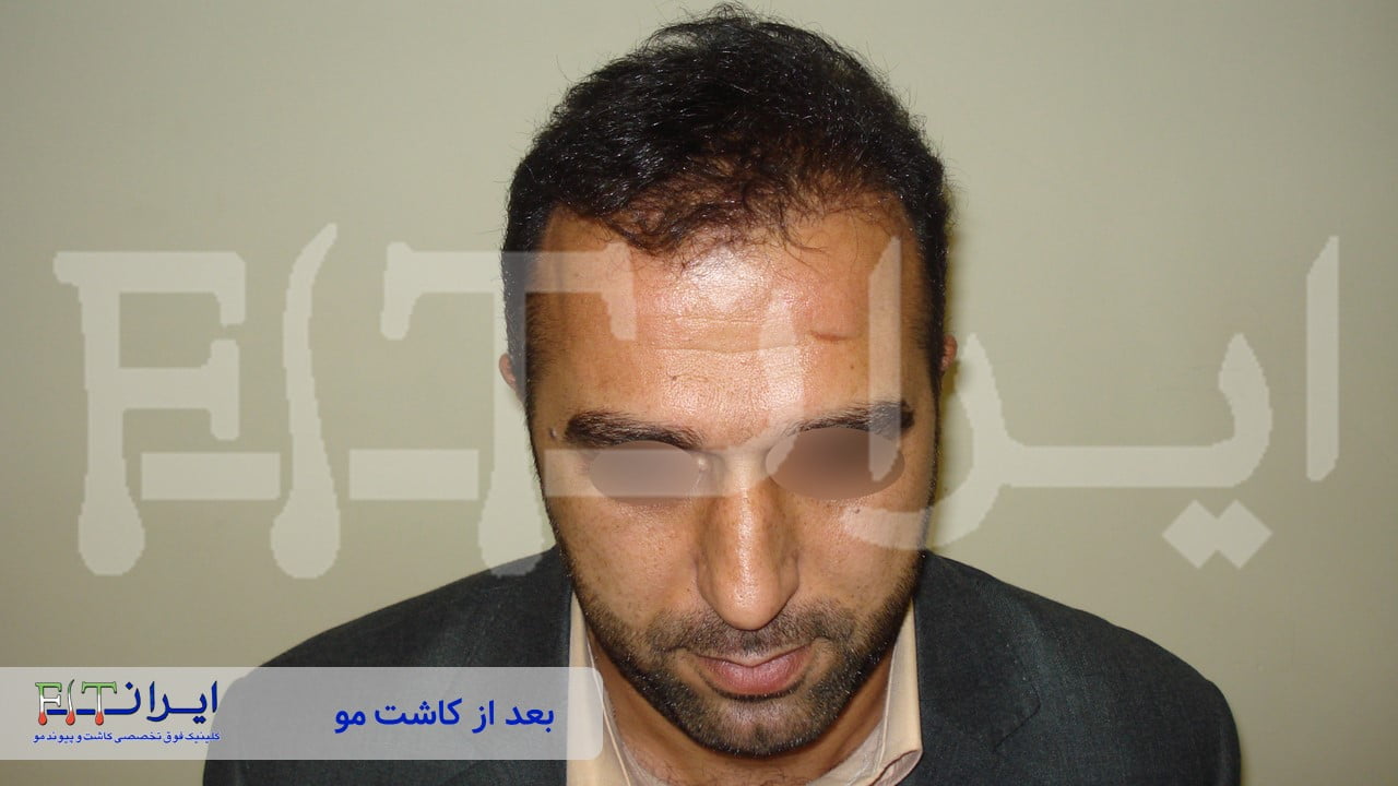 قبل و بعد از کاشت مو