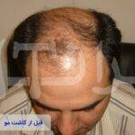 قبل و بعد از کاشت مو