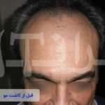 قبل و بعد از کاشت مو