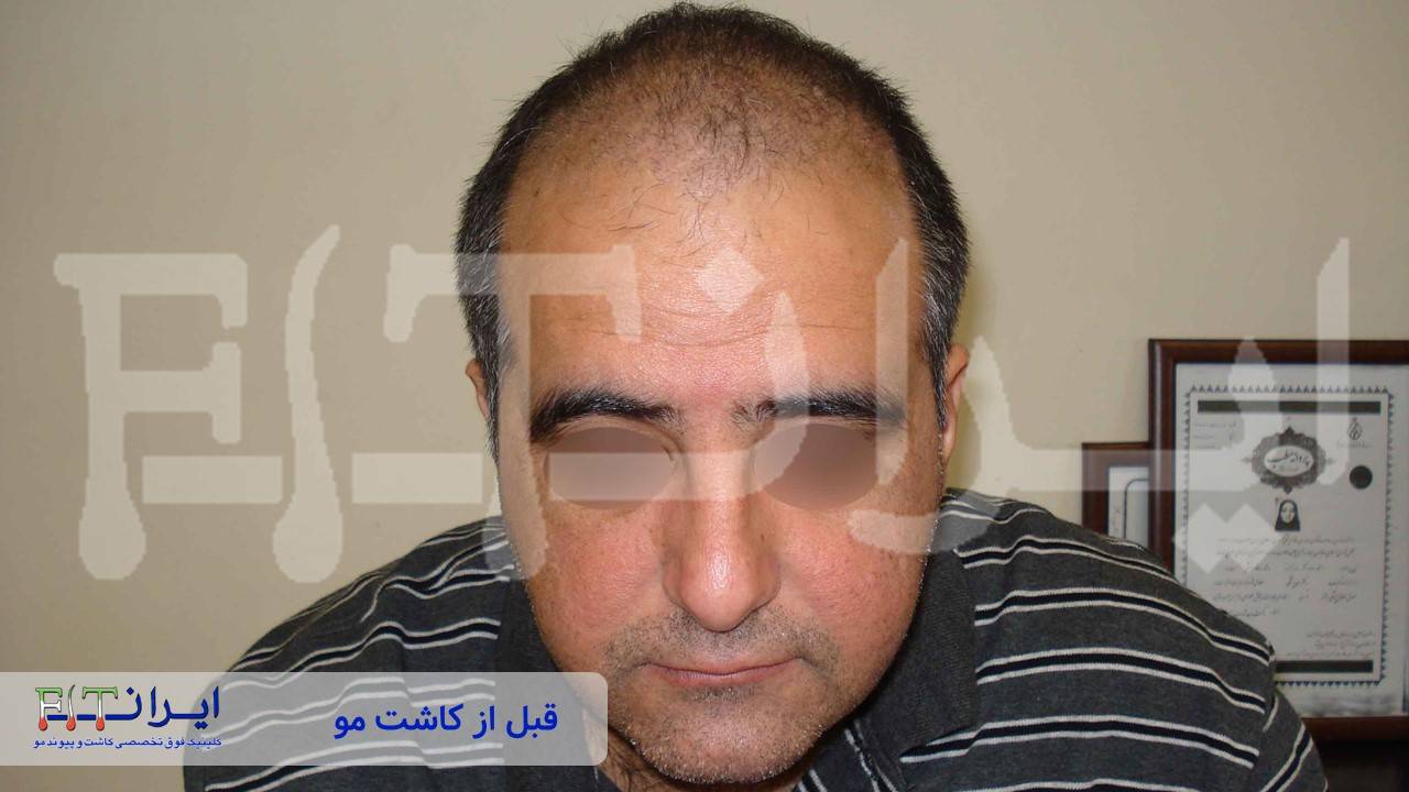 قبل و بعد از کاشت مو