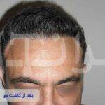 قبل و بعد از کاشت مو