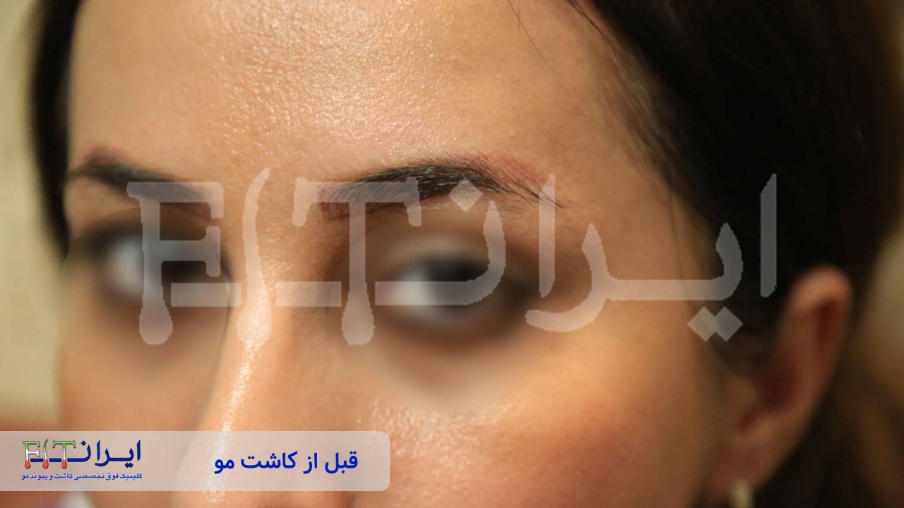 قبل و بعد از کاشت ابرو