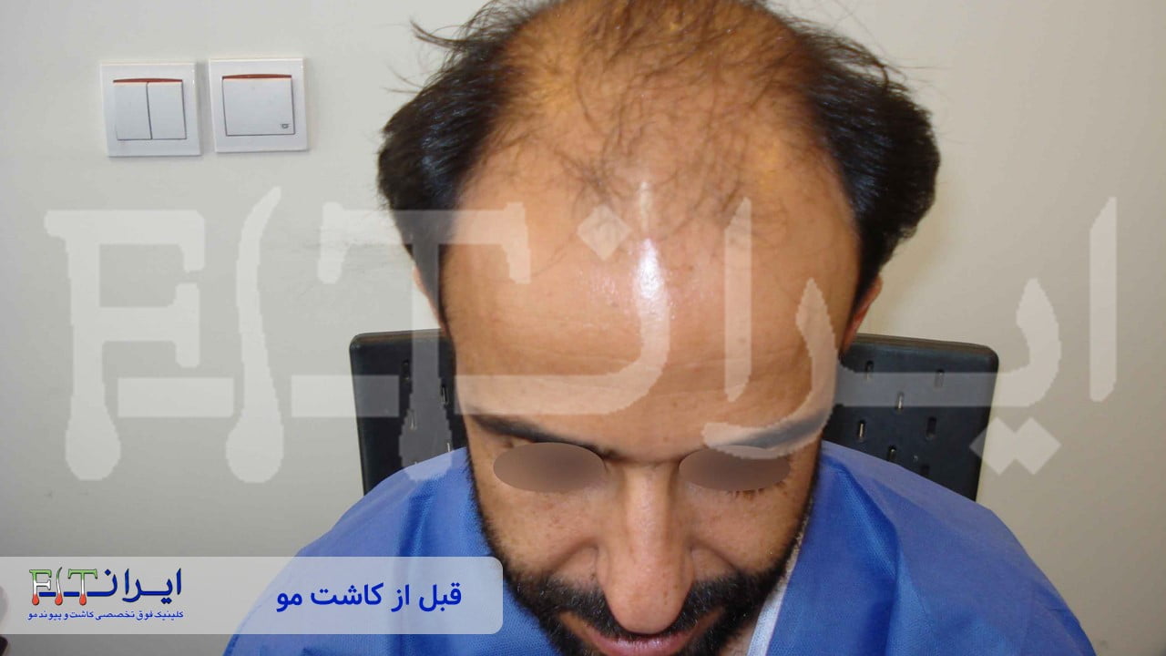 قبل و بعد از کاشت مو