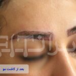قبل و بعد از کاشت ابرو