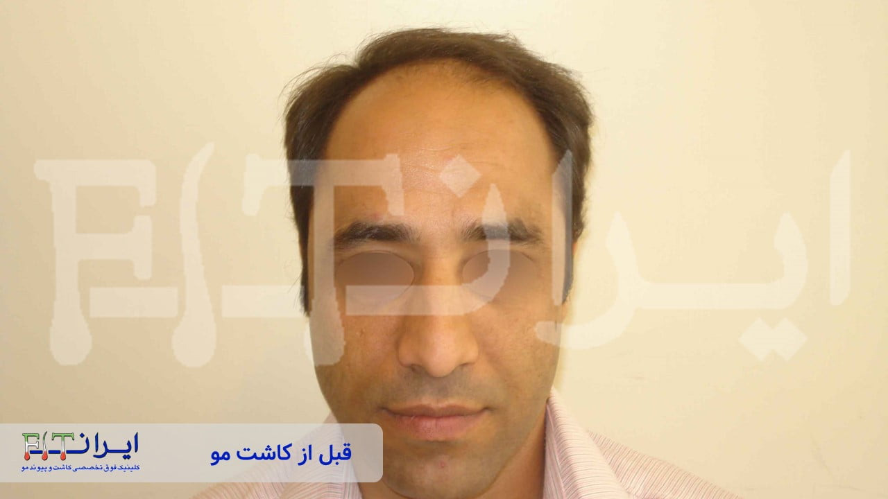 قبل و بعد از کاشت مو