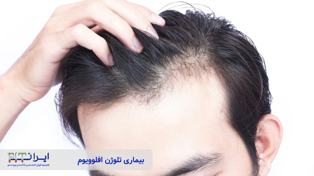 بیماری تلوژن افلوویوم بیماری تلوژن افلوویوم