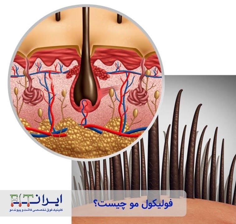 فولیکول مو