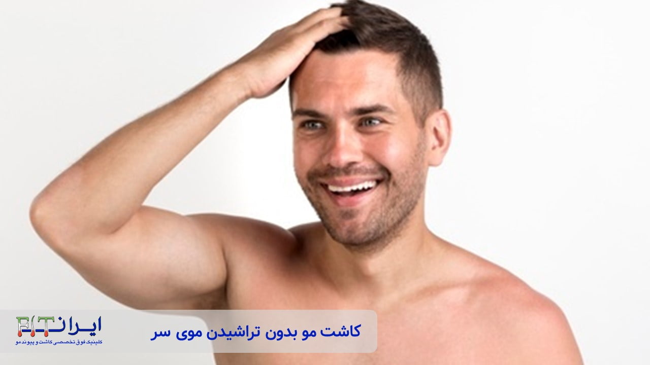 کاشت مو بدون کچلی