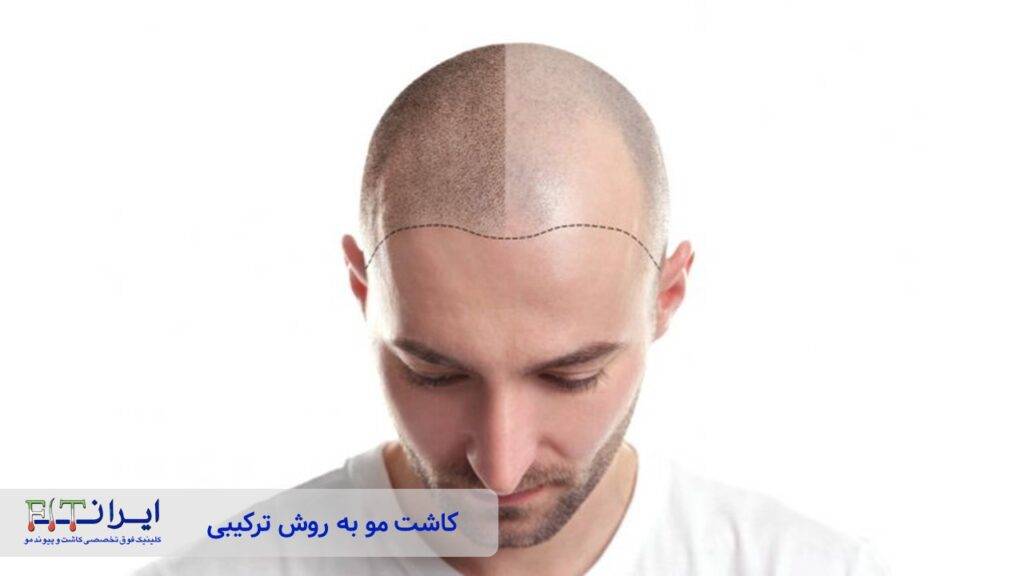 کاشت مو ترکیبی