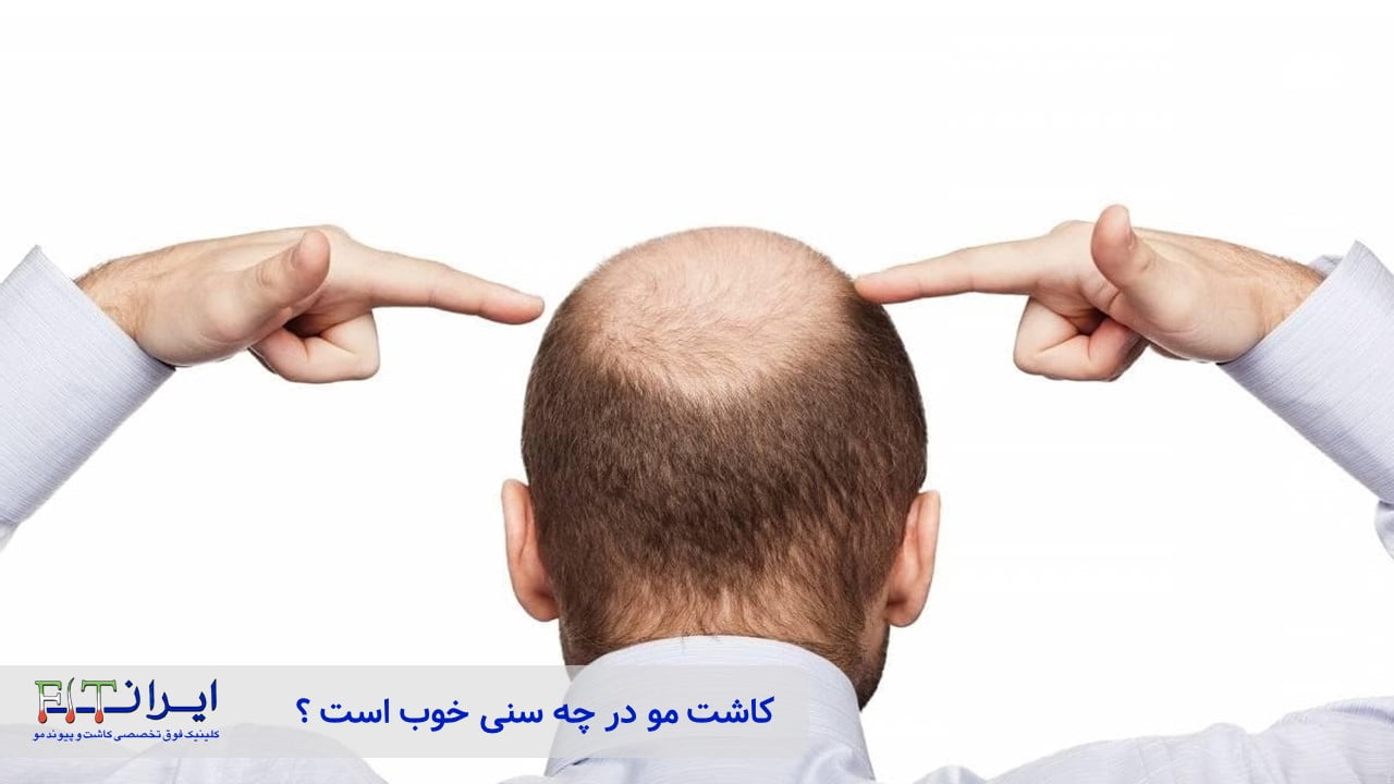 کاشت مو در چه سنی خوب است ؟