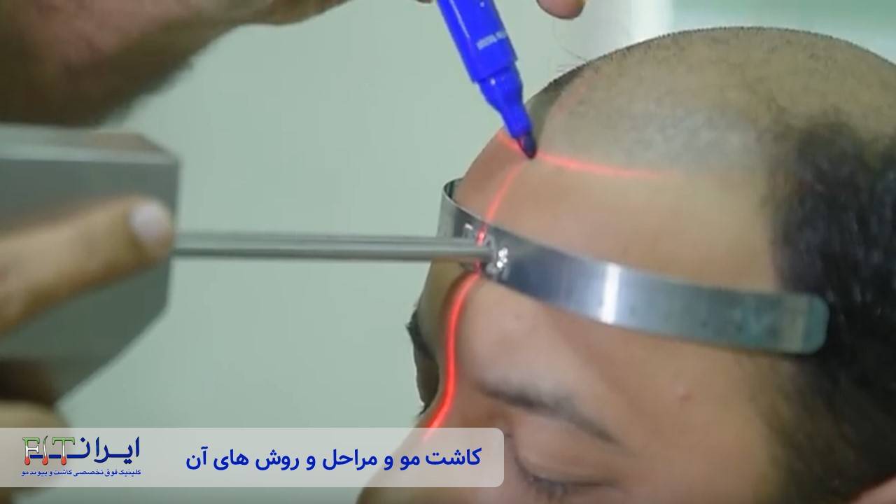 مراحل کاشت مو